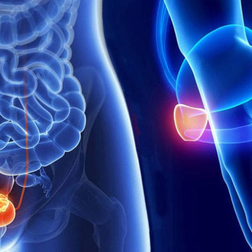 La relación entre los disruptores endocrinos y el cáncer de próstata